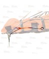 Kit anti rotación para camillas elevadas por helicóptero